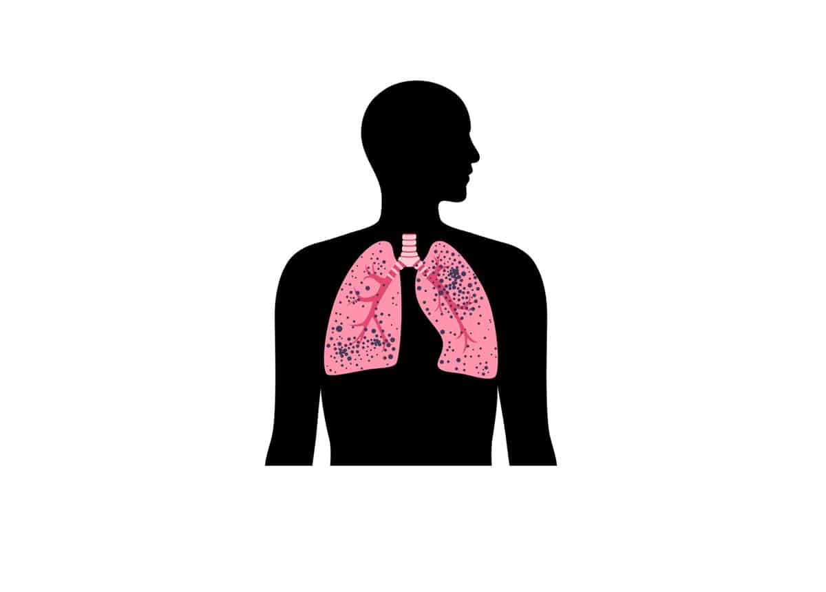 Silicosis